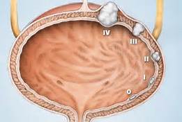 bladder_cancer