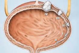 bladder_cancer