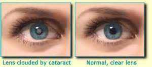 cataract