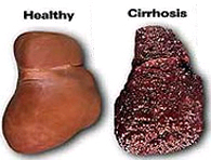 cirrhosis2