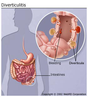 diverticulitis