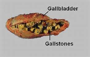 gallstones