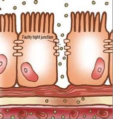 leaky_gut_syndrome2