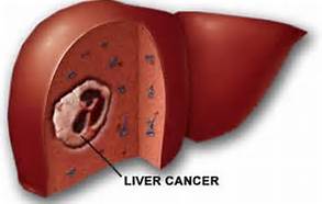 liver_cancer