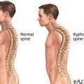 osteoporosis_in_men