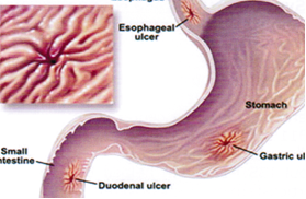 peptic_ulcers