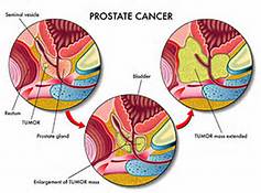 prostate_cancer