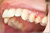 receding_gums