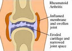 rheumatoid_arthritis