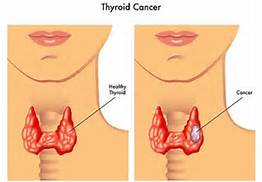 thyroid_cancer